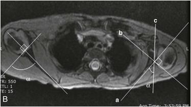 10 el - Glenohumeral Anteversion Protokoll finns på MR5 PD FSE 3 mm Bilateral PD FS 3 mm