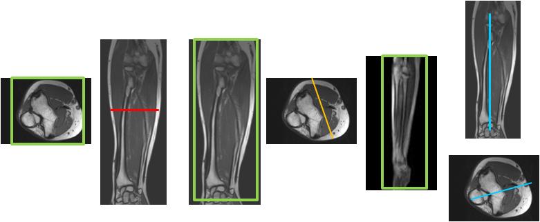 15 Överarm/Underarm - OM/ONK T2 FSE Flex 3 mm (0-10 år) 5 mm (11-17 år) T2 FSE FS 3 mm Båda leder skall vara med på bilden (0-10 år) 5 mm (11-17 år) Båda leder skall vara med på bilden STIR 4 mm Båda