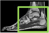 43 Fotled/Bak- och mellanfot - Coalitio PD FSE FS 3 mm FOV 1 cm ovanför distala tibia epifysen till ca 1 cm distal om epifysen metatarsale 1.