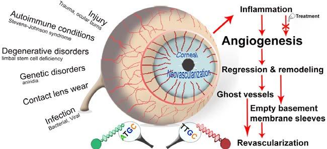 2. RESEARCH QUESTIONS AND FINDINGS IN THIS THESIS Corneal neovascularization is a clinical challenge, mainly due to the lack of safe and effective treatments.