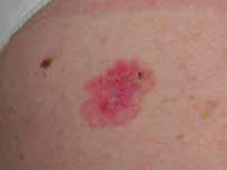 Vid behandling med fotodynamisk terapi med Metvix (metylaminolevulinat) förstörs enbart de skadade cellerna som avses att behandlas medan frisk hud inte skadas.