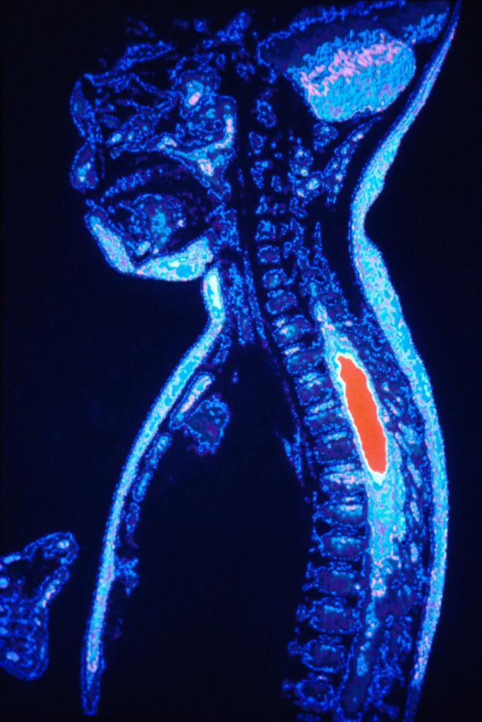 Carcinoma < 1-2% Severe hypercalcemia Locally infiltra@ng tumor Slowly growing
