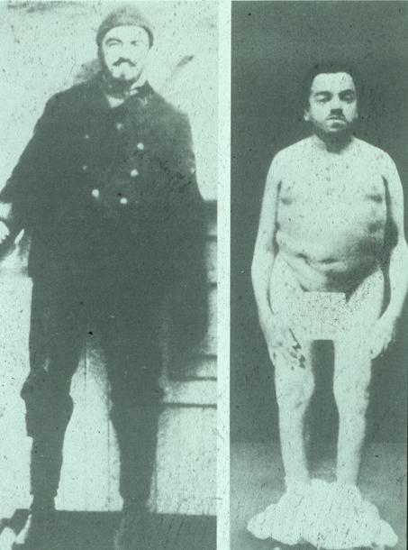 History of HPT Kapten Charles Martell behandlades för HPT med invalidiserande osteitis fibrosa cystica, genomgick 6 operationer vid Mayokliniken inkluderande total tyroidektomi och excision av 2