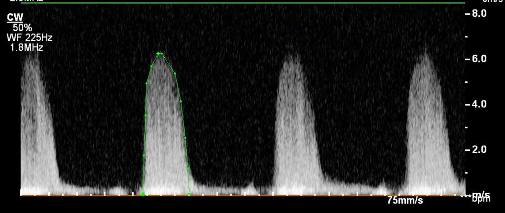 Bulwer, Rivero 2017 Aortaklaffens V-max och medelgradient: Intra- och interobserver variability ~ 3-4 % En peak