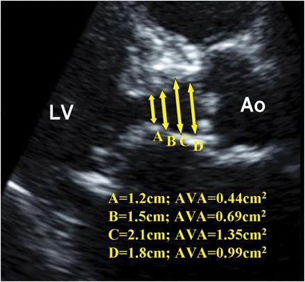 Arieta and Pomi Teoretisk LVOT diameter = 5.7 x BSA + 12.