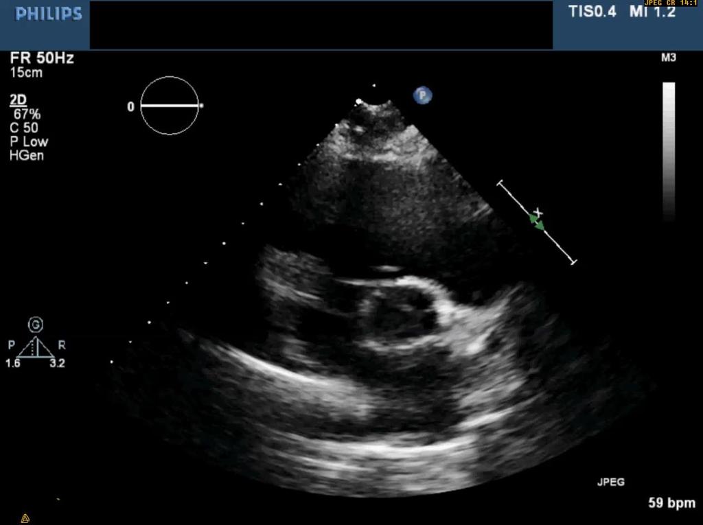 LVOT ofta ellipsoid