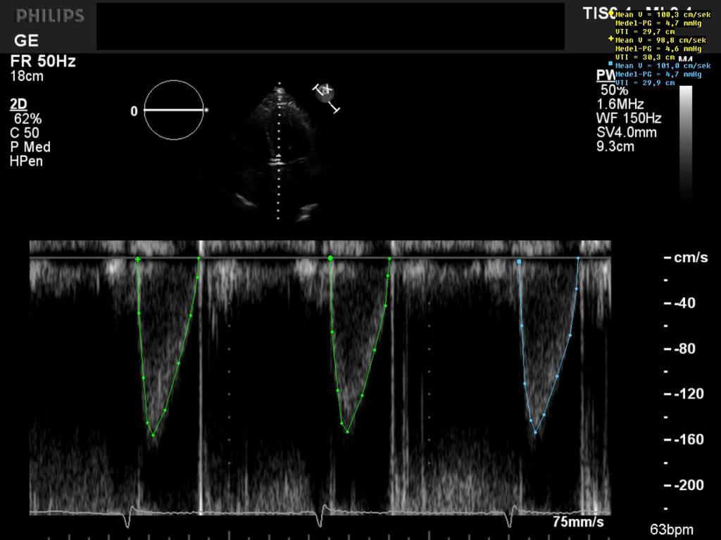 LVOT flödehastighet och flödesintegral (VTI): Intra- and