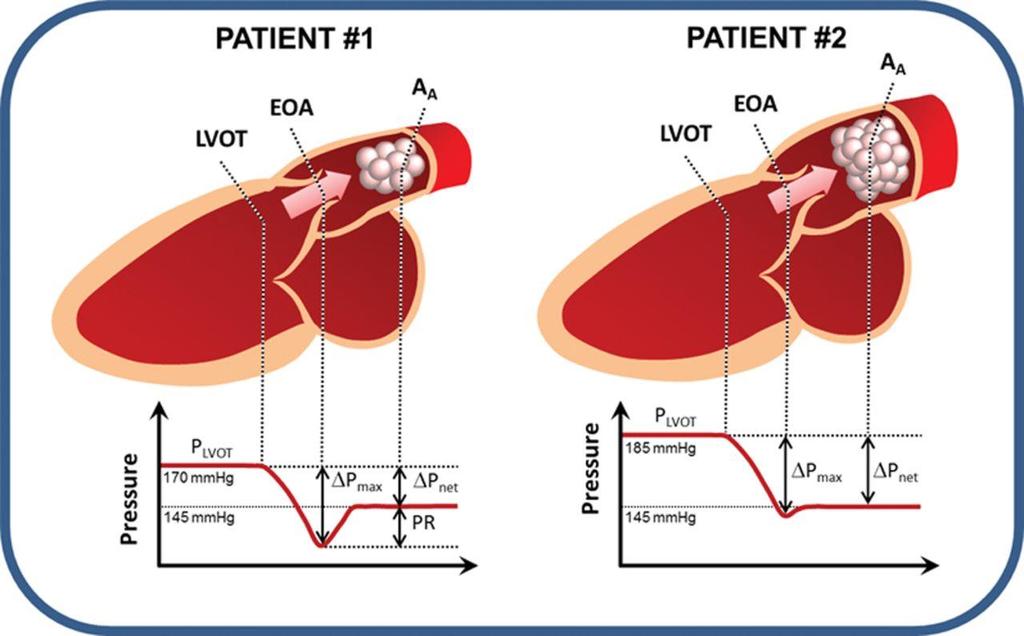 Pressure recovery (PR): Relaterar till omvandlingen mellan - potentiell energi (P) - kinetisk energi (V) - Värme Störst betydelse vid: - Aorta asc diameter < 3 cm -