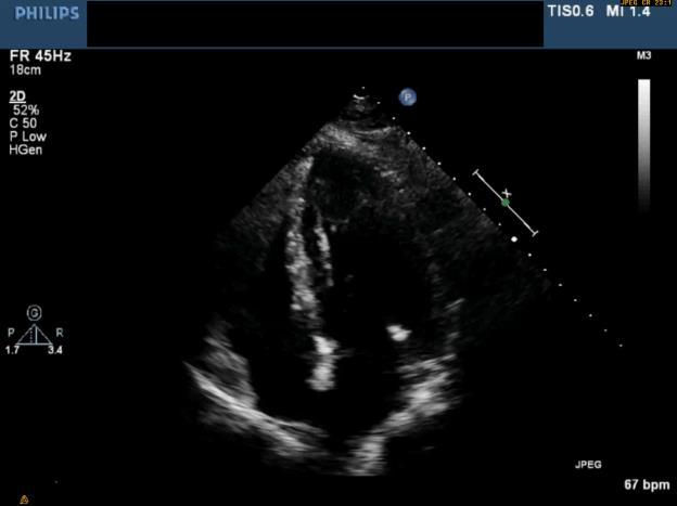 Low Flow, Low Gradient AS with Preserved Ejection