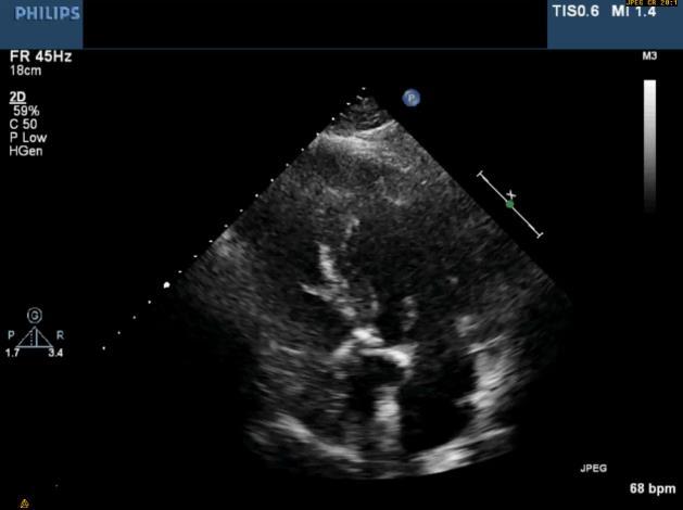 0 cm2 - Medelgradient < 40 mmhg - LVEF normal -