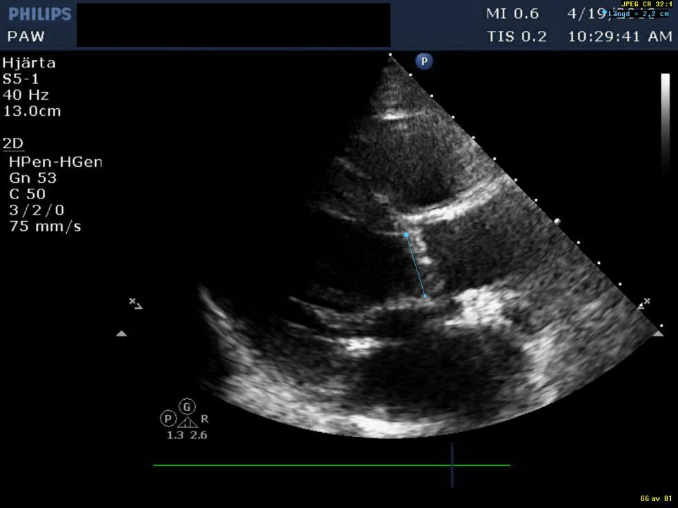 Low Flow, Low Gradient AS with Preserved Ejection Fraction: - Uteslut mätfel (LVOT-diametern / area vanligaste felkällan) TEE, CT?