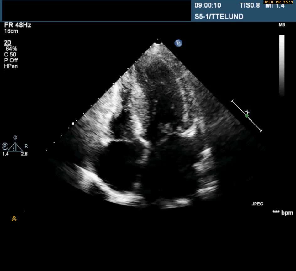 Differential diagnoser: Hypertrof