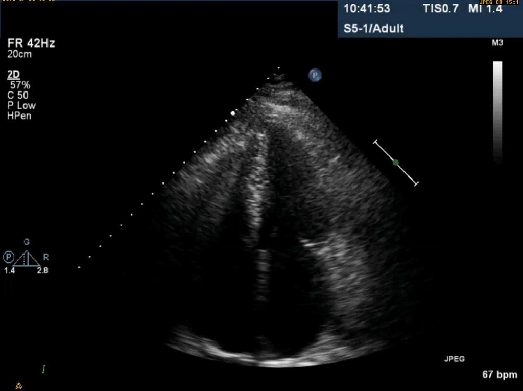 Amyloidos vid aortastenos - Ökad prevalens hjärtamyloidos ses vid