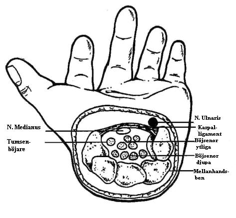 VÅRDRUTIN 2 (15) Tidiga symptom är domningar och/eller värk nattetid i tumme, pek- lång- eller ringfinger. Många patienter upplever att hela handen domnar dvs även lillfingret.