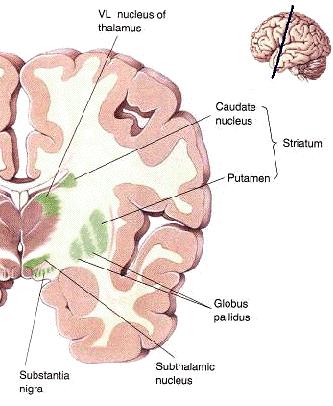 Neurotoxiska effekter - manganism Sällsynt tillstånd som kan uppträda vid långvarig exponering för mycket höga lufthalter mangan >1mg/m 3 Beskrevs av James Couper 1837: On the effects of black oxide