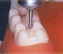 DF836KR012 Cylinderformad diamant DF830L014 Päronformad diamant Lång DF837KR010 Cylinderformad diamant DF830012C