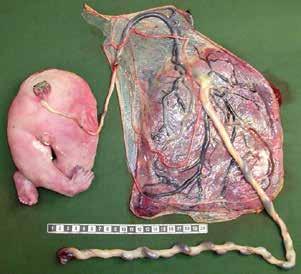 Figur 3. Monokorionisk tvillingplacenta vid reverserad arteriell perfusion (twin reversed arterial perfusion sequence; TRAP) och det akardiska fostret.