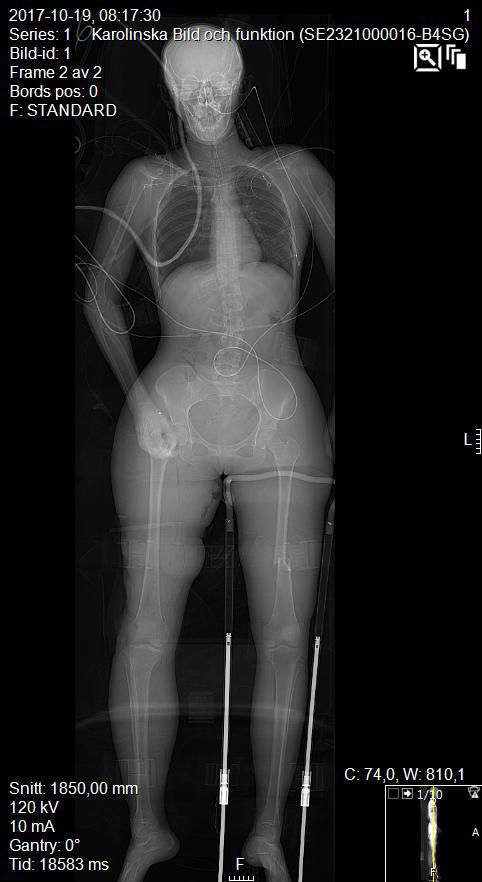 Damage Control Orthopaedics (DCO) ( eller ETC