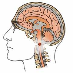 B Andning B i L-ABCDE står för Breathing (andning). Normal andningsfrekvens är 12-20 andetag/minut. När andetagen är färre än 10/minut kan orsaken vara t.ex. förgiftningar eller skallskador.