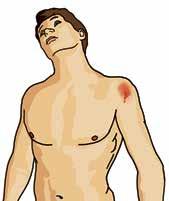 C Cirkulation och blödning C i L-ABCDE står för Circulation and bleeding (cirkulation och blödning). Kapillär-, venös- och artärblödning. I samband med de flesta olycksfall skadas blodkärl.