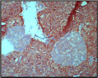 Notch activity is also necessary to maintain the neoplastic phenotype induced by Ras signalling. 26 There is also evidence that crosstalk exists between Notch and NFκB signalling pathways.