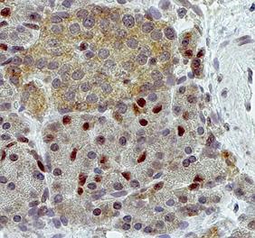 Tumours show lack of nuclear HES1 All PETs, well-differentiated and poorly-differentiated endocrine carcinomas but also the well-differentiated tumours such as benign insulinomas, demonstrated