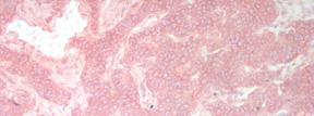 Figure 9) NOTCH1 immunoreactivity in PET (x100). HEY1 expression was observed in both the cytoplasm and the nucleus of PETs.