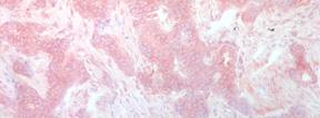 All the non-tumourous pancreatic endocrine specimens were invariable HEY1 immunoreactive.