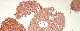 A B Figure 13) menin immunoreactivity in a Men1 +/- mouse, partial or total loss of menin can be observed, x200 (A) menin immunoreactivity in tumour (B) menin immunoreactivity in isolated islets,