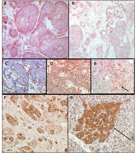 Figure 18) Immunoreactivity of ASCL1, DKK1, and TPH1 in PETs and nontumourous pancreatic specimen. Pancreatic islets are indicated by arrows.