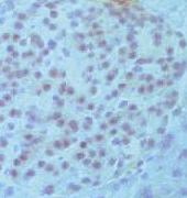 qpcr analysis of PDX1 and DKL1 expression showed that insulinomas had higher levels of these factors, compared with other tumour types. However, this was not observed by immunohistochemisty.