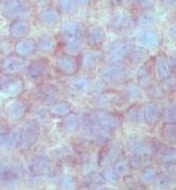 The majority of tumours showed both cytoplasmic and nuclear expression, although some expressed NEUROG3 only in the cytoplasm (Figure 19 C).