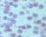 A B Figure 20) Immunohistochemistry of NEUROD1, (A) non-tumourous pancreatic specimen from wt mice, predominantly nuclear expression, x200, (B) PET from a MEN 1 patient, predominantly cytoplasmic