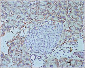 In one of the non-tumourous MEN 1 pancreatic specimens, POU3F4 expression was weakly positive, whereas the remaining two were negative for POU3F4.