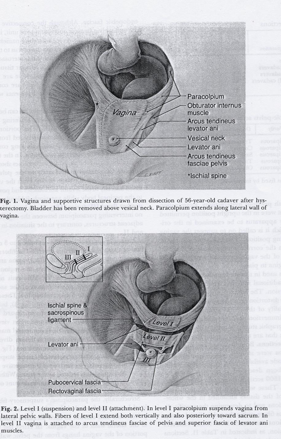 Level I - suspension Den övre delen av vagina, apex, stöds från bäckenväggarna av Lig.