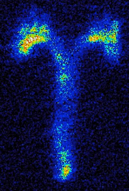 Results and Discussion Blomberg et al. (2014) suggested that the SUVmax of the carotid plaque is the most reliable surrogate for plaque vulnerability.