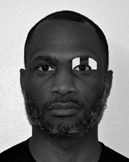 Regional Nerve Blocks of the Face 521 Fig. 3. Lacrimal nerve distribution. (Courtesy of Alisa Gibson, MD, DMD. University of Maryland School of Medicine, Baltimore, MD.