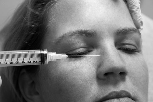 522 Moskovitz & Sabatino Fig. 5. Dorsal nasal nerve distribution. (Courtesy of Alisa Gibson, MD, DMD. University of Maryland School of Medicine, Baltimore, MD.