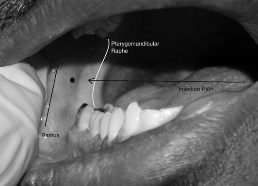 Regional Nerve Blocks of the Face 525 Fig. 12. Intraoral nerve anatomy and approach. (Courtesy of Alisa Gibson, MD, DMD. University of Maryland School of Medicine, Baltimore, MD.