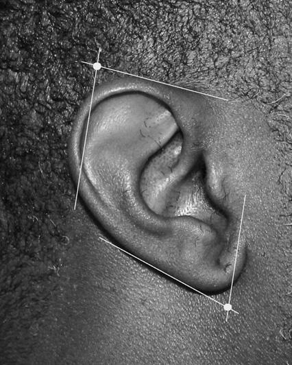 One should simply withdraw slightly (no more than 1 mm) and aspirate again, then inject 4 to 5 ml. 10 Laceration of the Ear The ear is anesthetized through ring-like blocks around it.