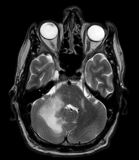 Fallbeskrivning Svensson med progressiv neurologi Patienten är en svensk man i 50-årsåldern, gift, yrkeschaufför, har Sjögrens syndrom och tidigare genomgått en gastric bypassoperation.