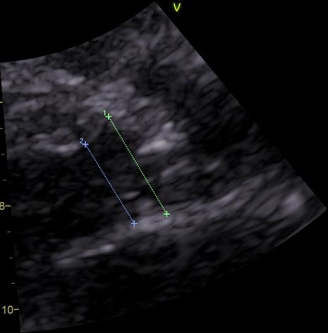 Annulus/LVOT