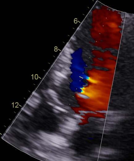 LVOT-VTI