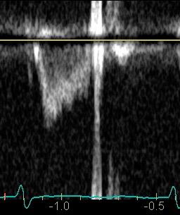 Har patienten verkligen low-flow?