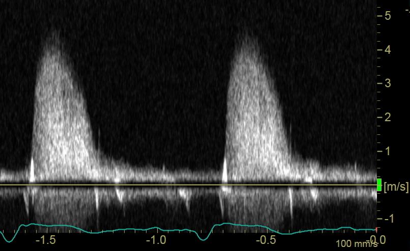 Doppler tryckgradienter Fall#1 Vmax 4.