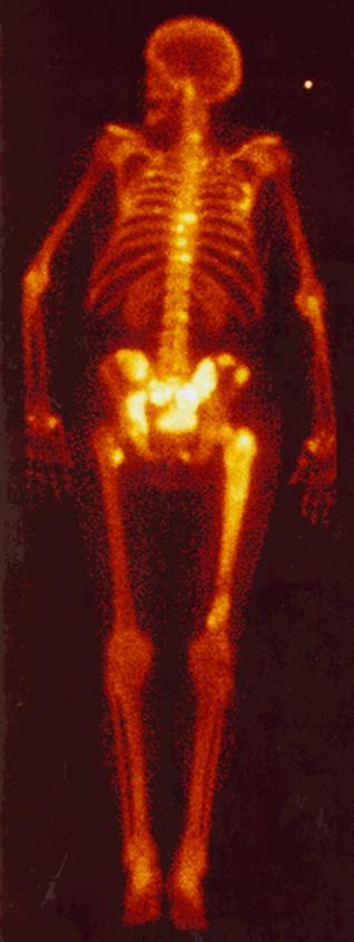 Skelettmetastaser Vanligaste metastaslokalisationen 50% Vanliga diagnoser: Bröstcancer Prostatacancer Lungcancer Njurcancer