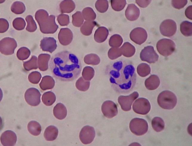 Neutropeni Neutropeni Neutr <0,5 Sjunker efter cytostatikabehandling 7-14 dagar Ökad risk för bakteriella