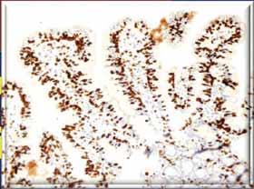 coeliac disease