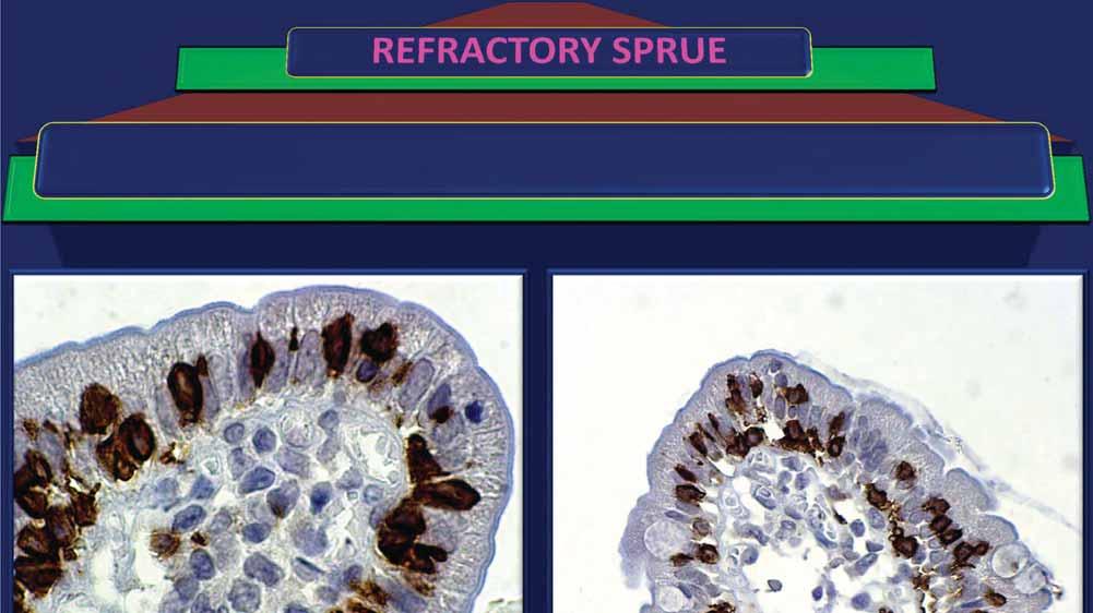 Treated celiac patients who