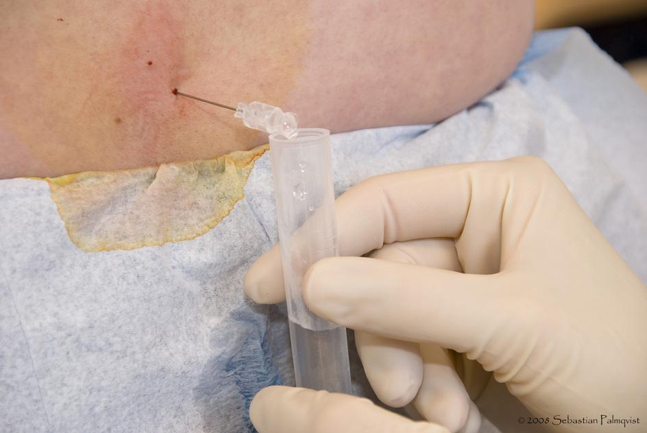 After local anaesthetic infiltration in the skin, a needle is inserted in the L3-L4 interspace